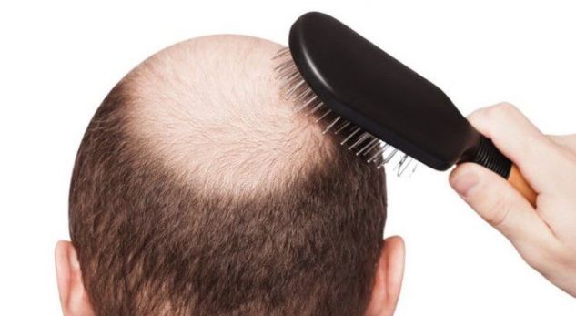 Një trajtim i ri kundër rënies së flokëve të shkaktuar nga alopecia