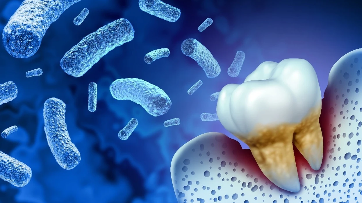 Sëmundja e mishrave të dhëmbëve mund ta përkeqësojë sklerozën multiple dhe ta rrisë invaliditetin