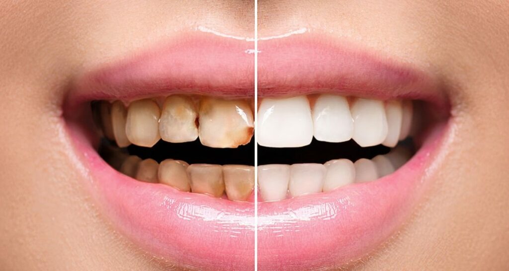 Mjaft me kavitete  Ky aminoacid natyral ndihmon dhëmbët të luftojnë sheqerin